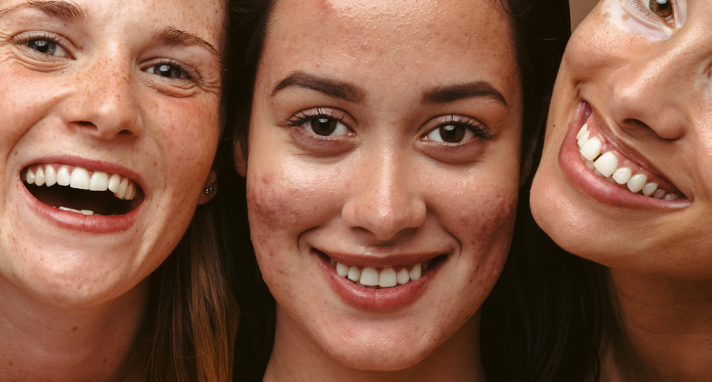 FREE Acne Consult + Treatment Featured Image
