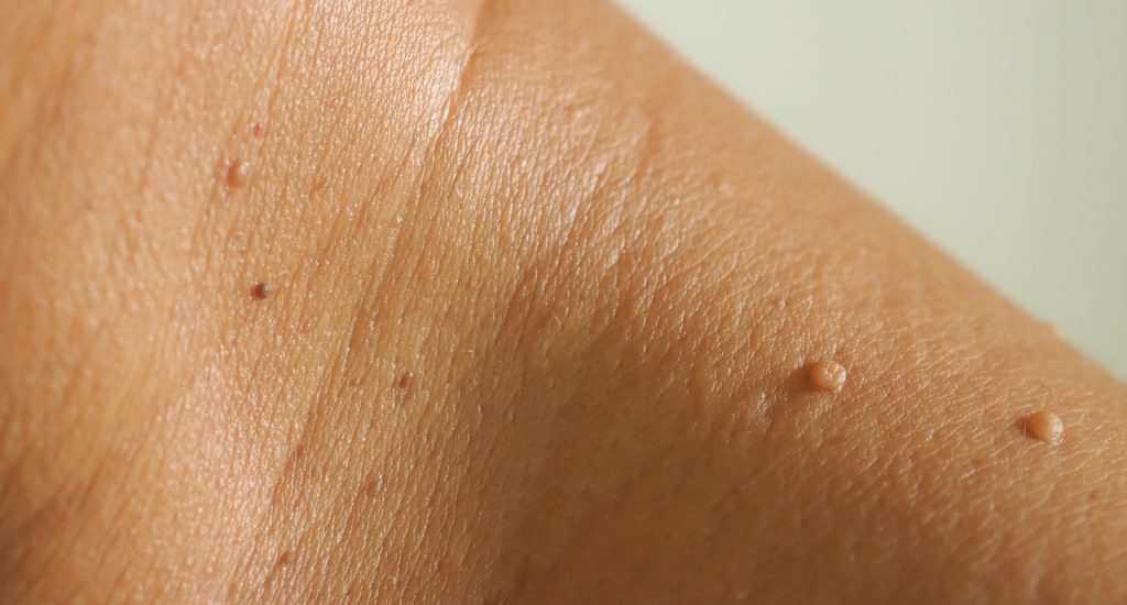 Skin Tag Removal - Single (10mins) Featured Image