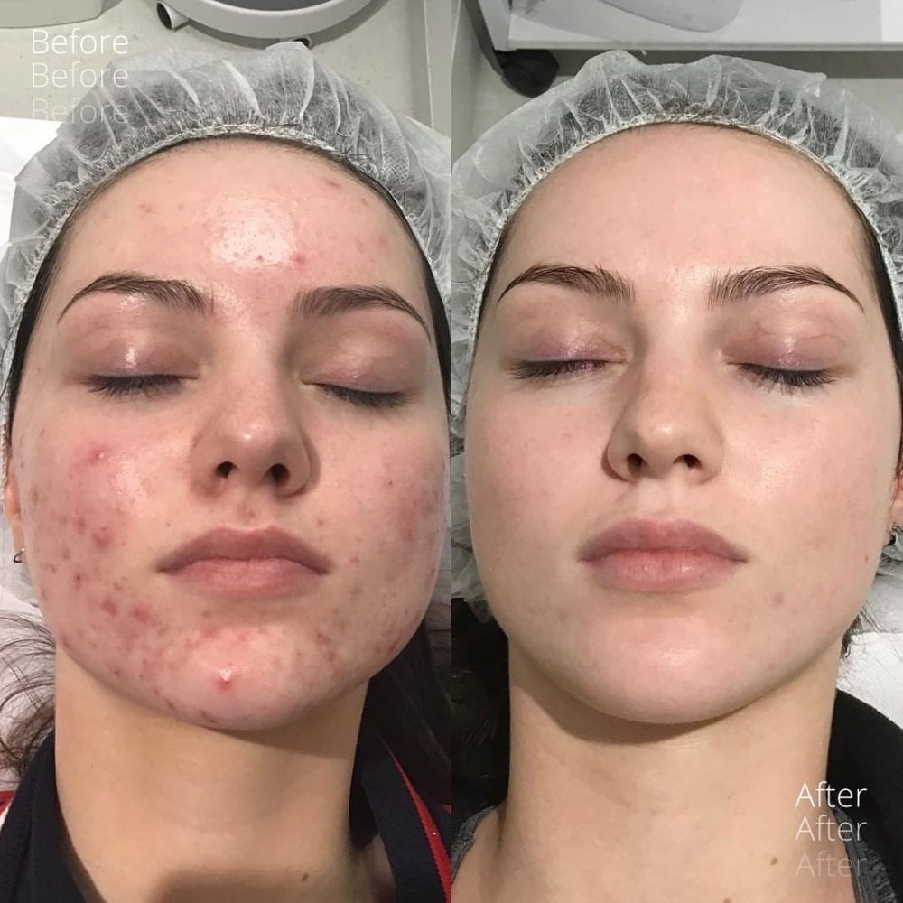 Signature Acne Treatment