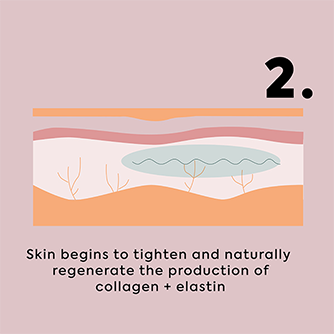 PDO Threads – Non-Surgical Skin Tightening Treatment | Clear Skincare