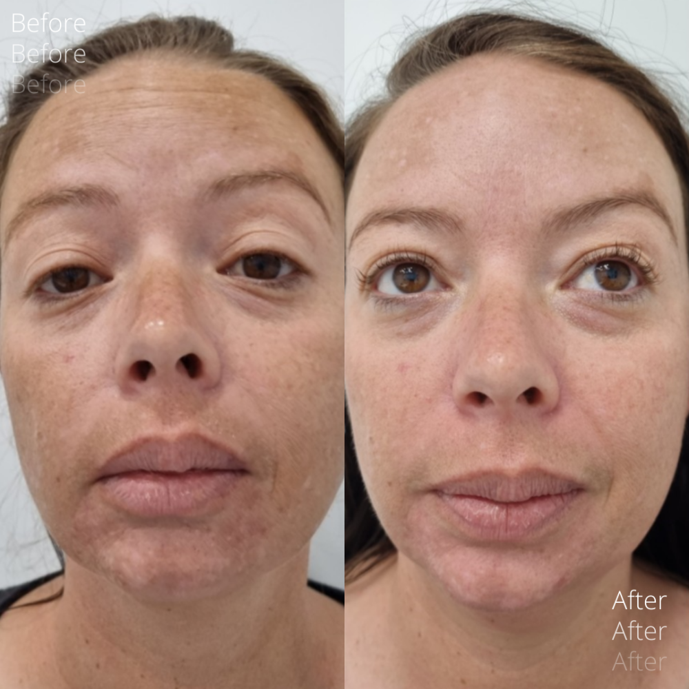 Microneedling