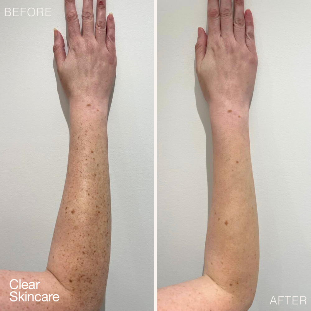 Laser Pigmentation Removal