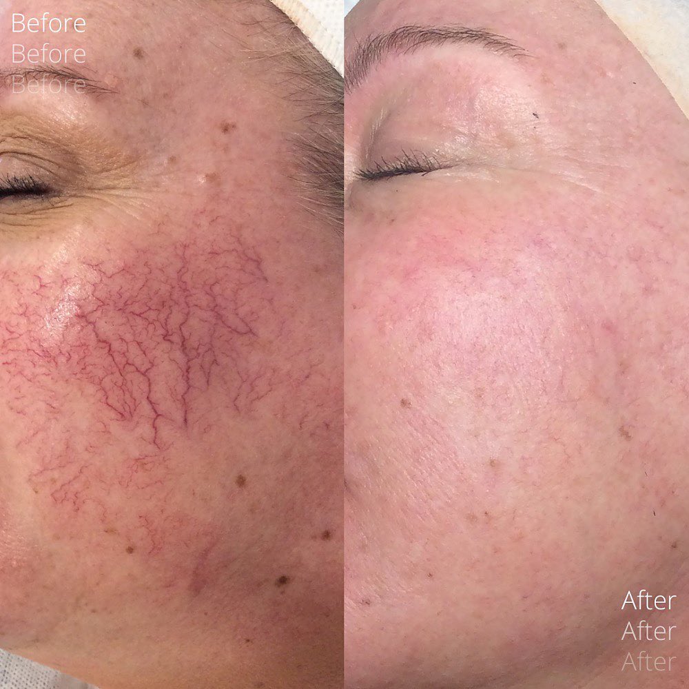 Red Vein B&A