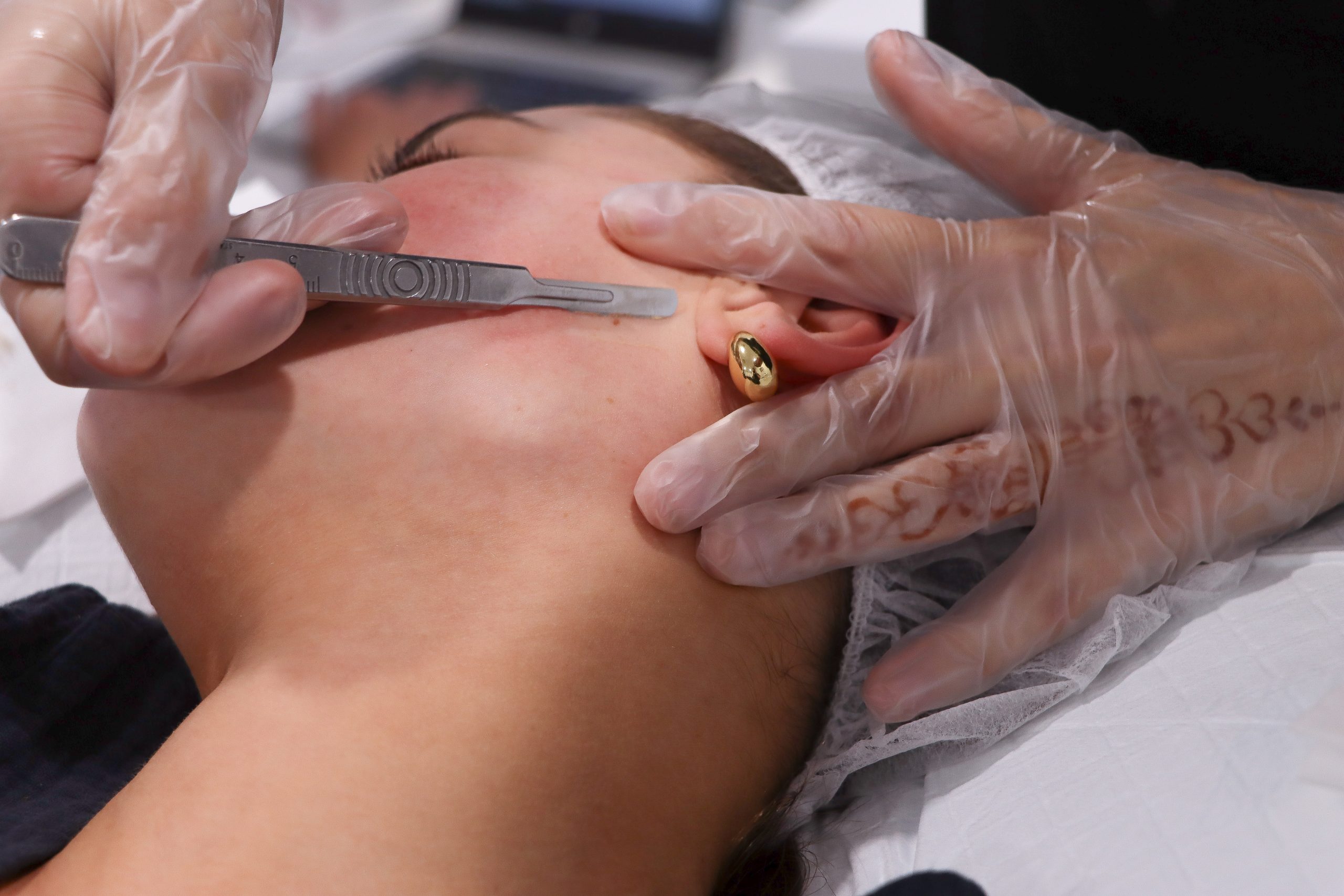 Dermaplanning