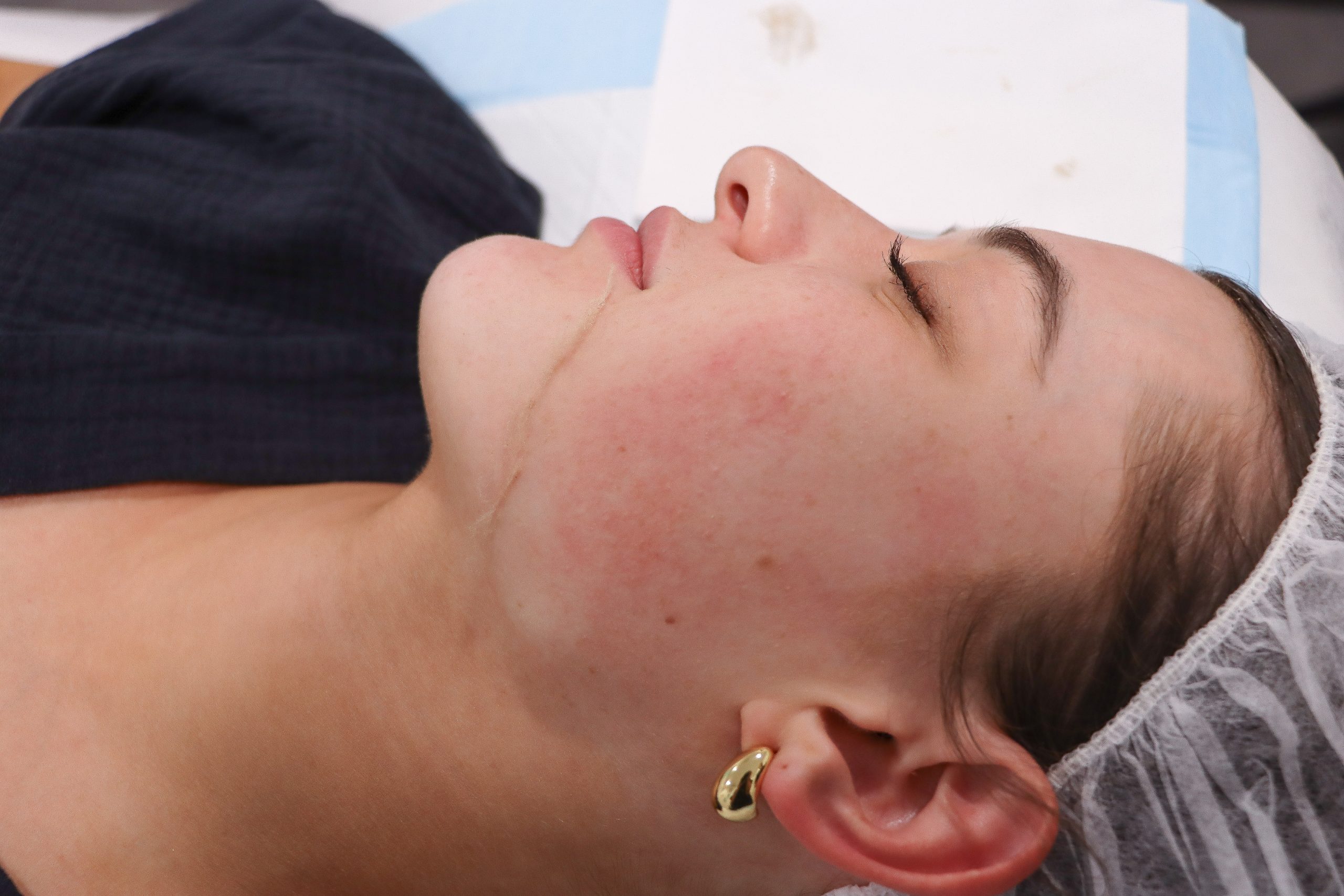 Dermaplanning